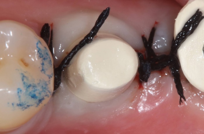 Clinical before view with sutured gingivaformer around the abutment-level workflow