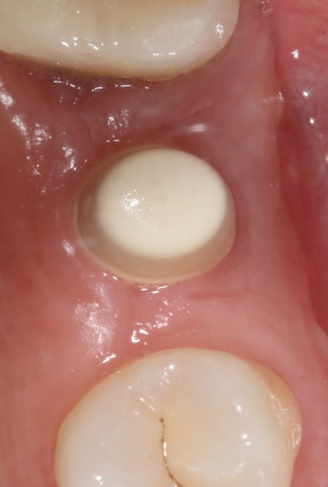 Clinical after view showing healed tissue around the gingivaformer