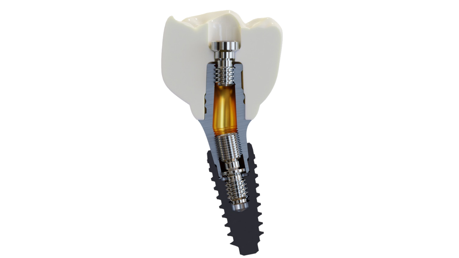 Angled screw-channel implant component shown as a clinical product cutaway