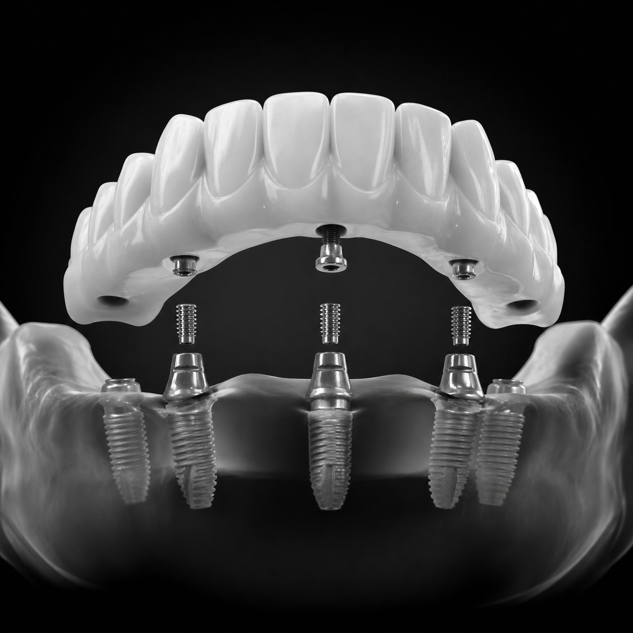 High-quality 3D render of one-day implant provisional restoration